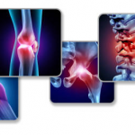 Shockwave Therapy for Knee Osteoarthritis 