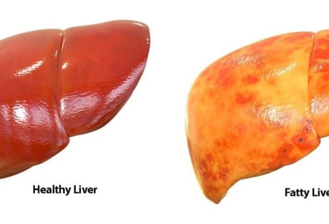 Reversing Fatty Liver: Lifestyle Changes And Medical Treatments