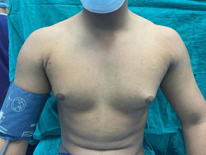 Gynecomastia